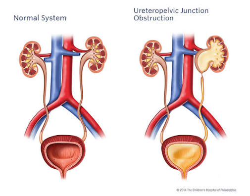 Endocystolithotripsy for bladder stones
